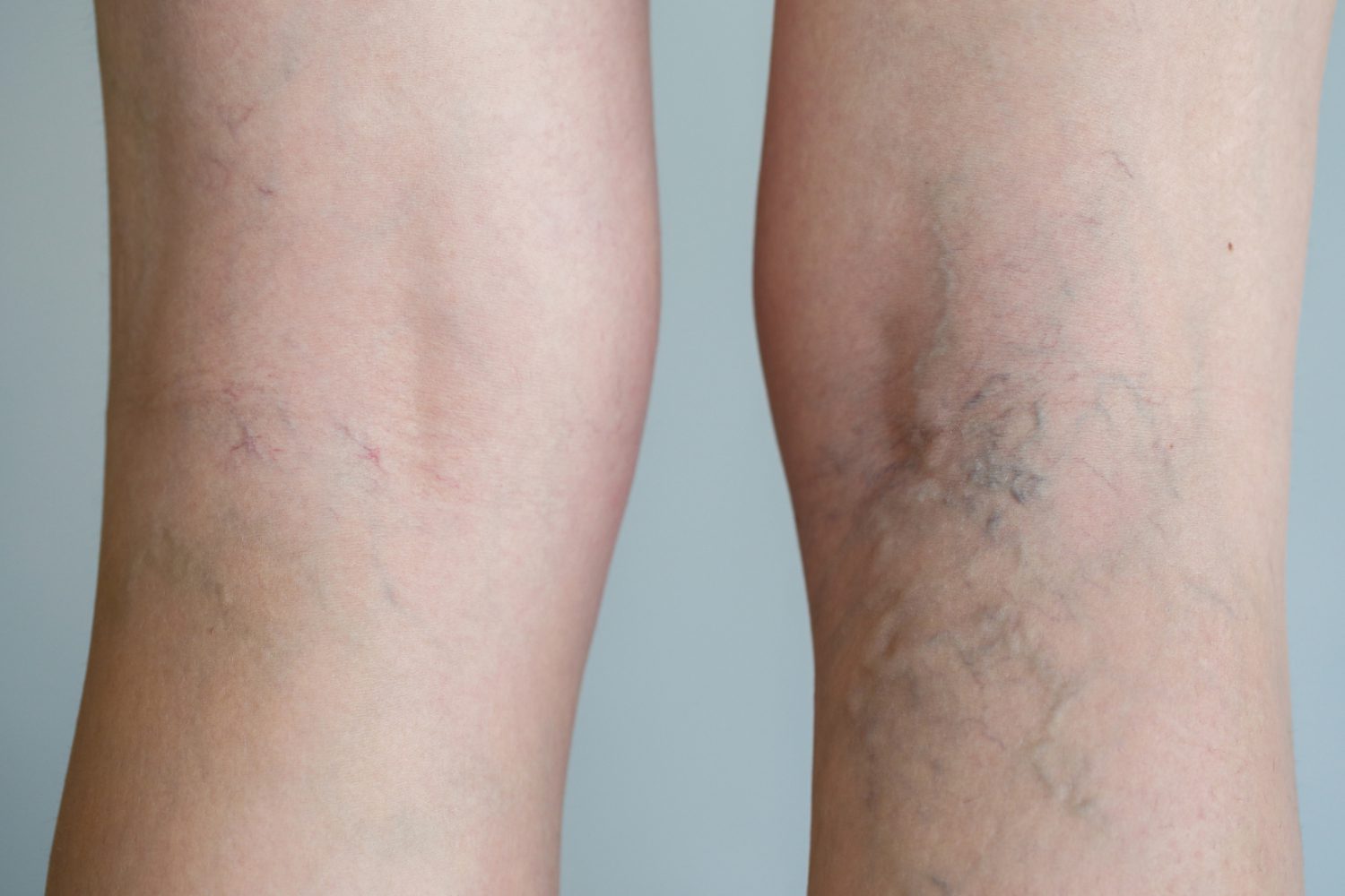 Varicose vein NYMVC