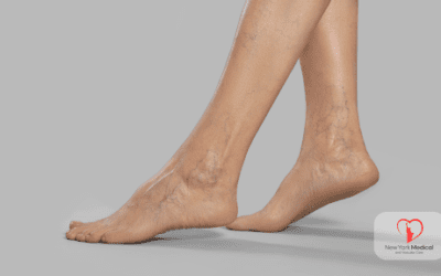 Understanding Venous Insufficiency and Its Treatments