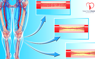 Understanding Peripheral Artery Disease (PAD)